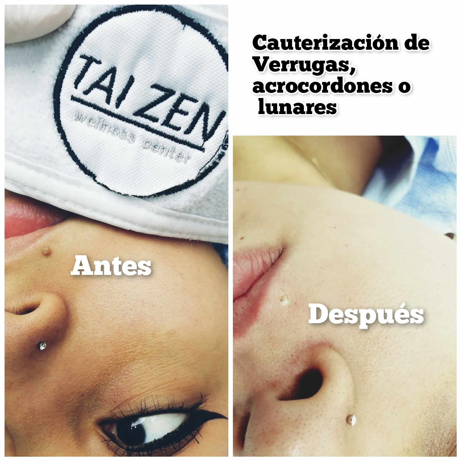 Cauterización de Lunares acrocordones y verrugas TAI ZEN SPA