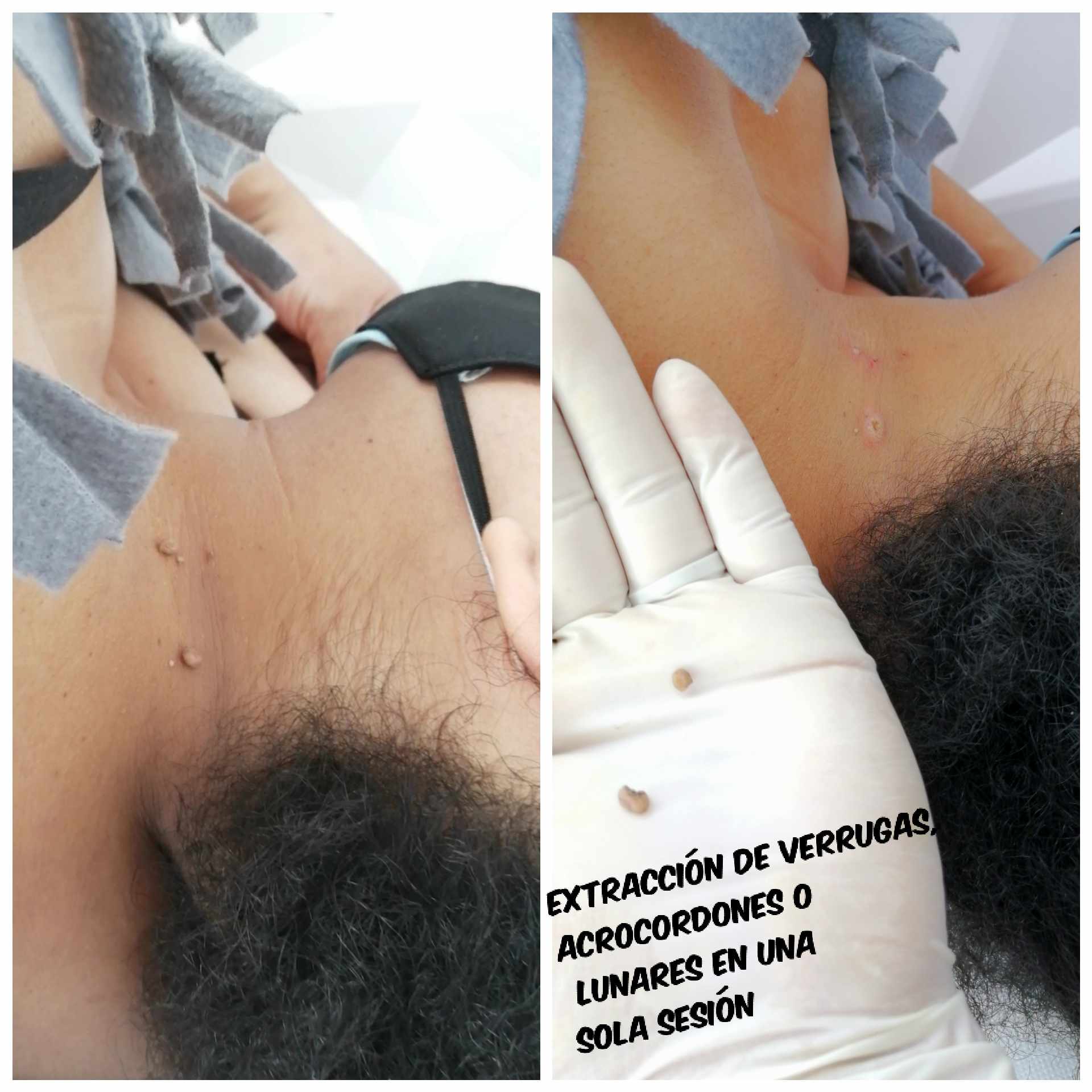 Cauterización de Lunares acrocordones y verrugas TAI ZEN SPA