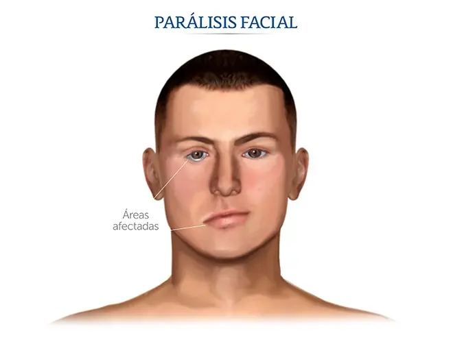 REHABILITACION FISICA NEUROLOGICA PARKINSON-ACV-GUILLINA BARRE-PARALISIS FACIAL