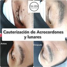 Cauterización de Lunares acrocordones y verrugas TAI ZEN SPA